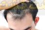 ریزش مو و رویش مجدد>