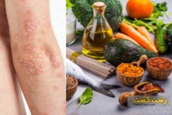 رژیم غذایی پسوریازیس