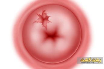 سوراخ شدن رحم