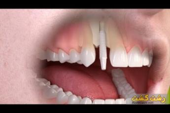 ایمپلنت زیرکونیا 