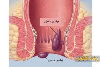 درمان بواسیر یا هموروئید