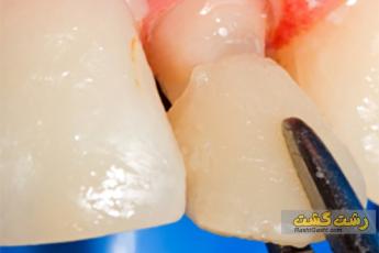  افتادن روکش دندان