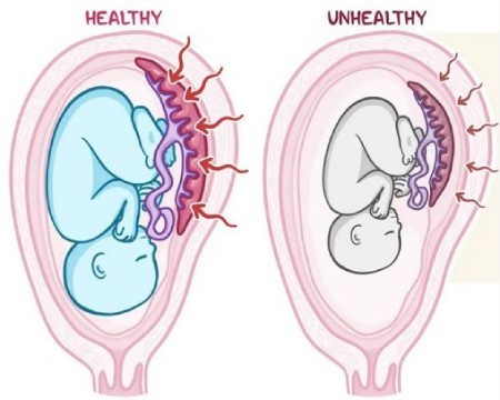 تصویر شماره محدودیت رشد داخل رحمی جنین