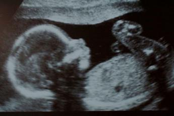 سونوگرافی nt چیست؟