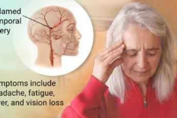 آرتریت تمپورال