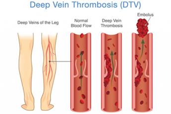 لخته خون در پا