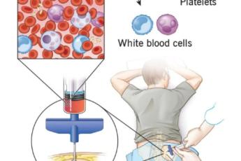 عوارض پیوند مغز استخوان