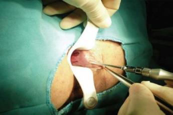 جراحی همرووئید با لیزر