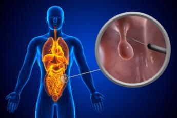 پولیپکتومی