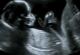 تفاوت جنین دختر و پسر در سونوگرافی