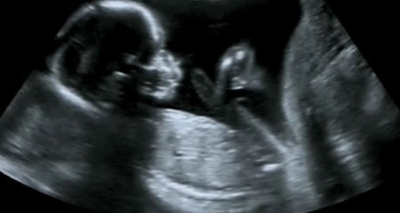 تصویر شماره تفاوت جنین دختر و پسر در سونوگرافی