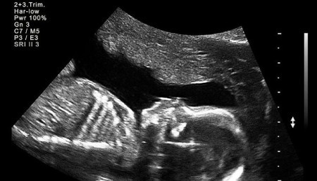 تصویر شماره تفاوت جنین دختر و پسر در سونوگرافی