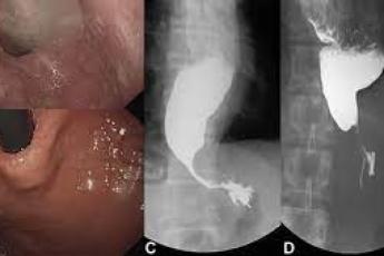 بوتاکس معده