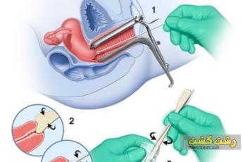 خونریزی بعد از پاپ اسمیر