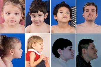 اختلالات مادرزادی گلیکوزیلاسیون