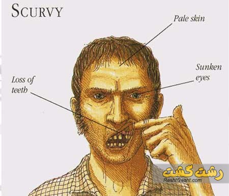 تصویر شماره بیماری اسکوربورت