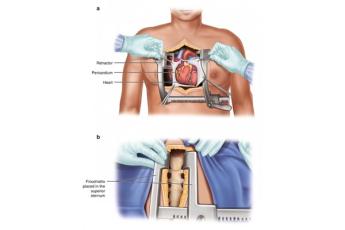 عمل قلب باز