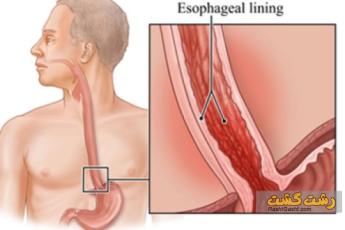 ازوفاژیت معده