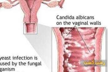 عفونت در بارداری
