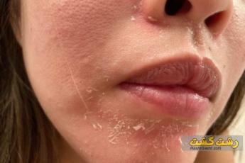 پوسته شدن بدن در آفتاب گرفتگی