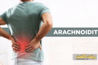 آراکنوئیدیت