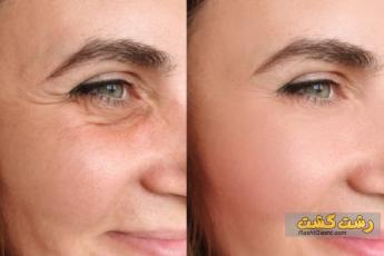 افتادگی پوست دور چشم