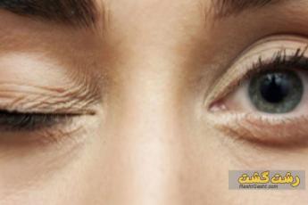 تیک عصبی چشم