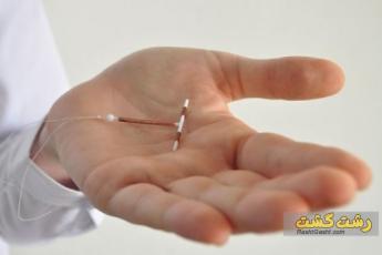 ایمپلنت ضد بارداری