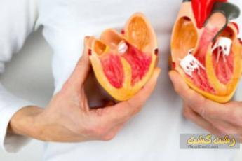 عمل قلب باز