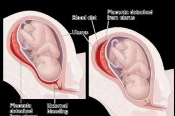 هماتوم در بارداری