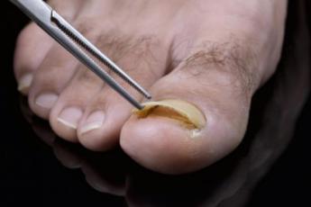 علت افتادن ناخن