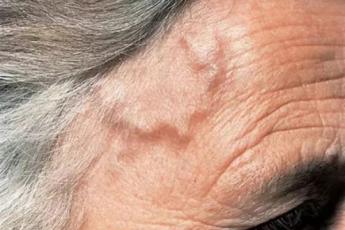 بیرون زدگی رگ پیشانی