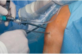 جراحی تاندن شانه