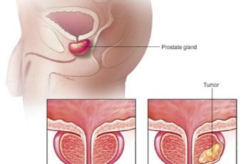 نشانه های مخفی سرطان پروستات