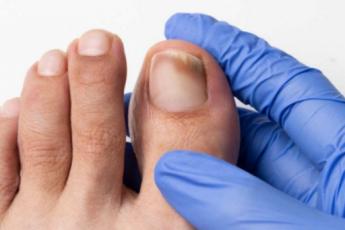 درمان قارچ ناخن