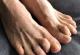 درمان خمیدگی انگشتان پا