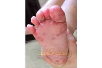 لکه‌های قرمز کف پا