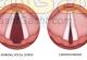لارینگواسپاسم یا اسپاسم حنجره
