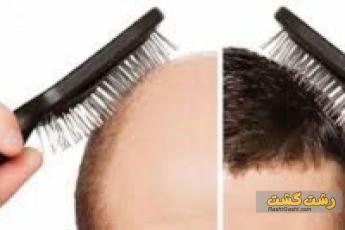 انواع کاشت مو