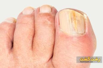 پسوریازیس ناخن