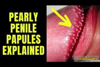 دانه های سفید روی اندام تناسلی مردان نشانه چیست ؟ 