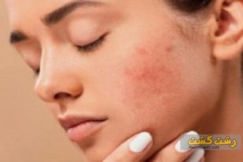 از بین بردن چین و چروک