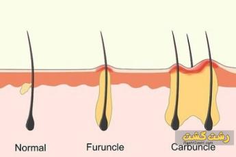 کفگیرک یا کربونکل پوست 