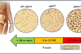 پوکی استخوان