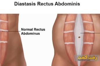 جدایش شکمی چیست؟