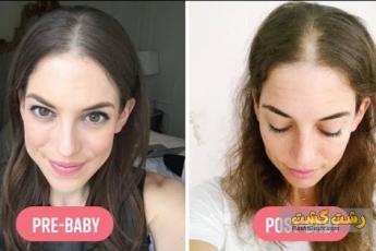 ریزش مو وبارداری