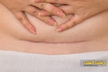 فتق بعد از سزارین: علائم، درمان و بهبودی