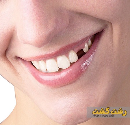 تصویر شماره غیبت دندانی