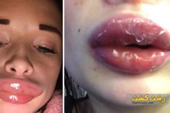 عفونت لب بعد از تزریق ژل