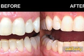 کانتورینگ دندان